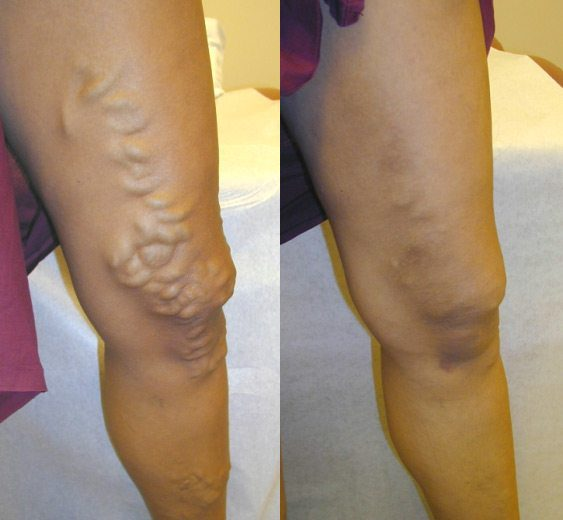 Healrize® LegRenew Varicose Veins Patch✨