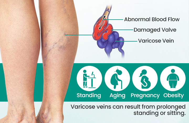 Healrize® LegRenew Varicose Veins Patch✨
