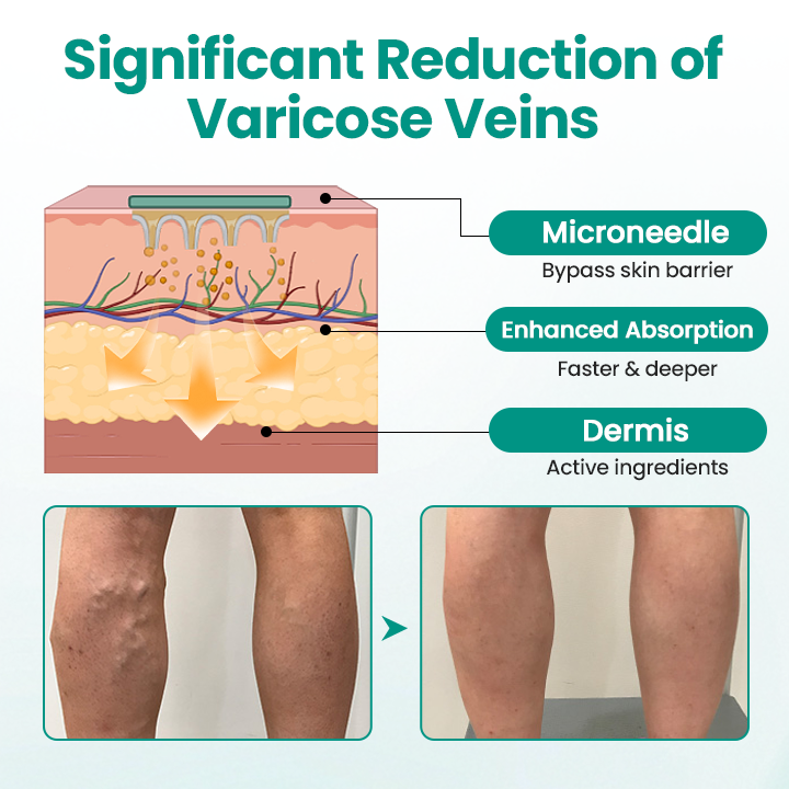Healrize® LegRenew Varicose Veins Patch✨