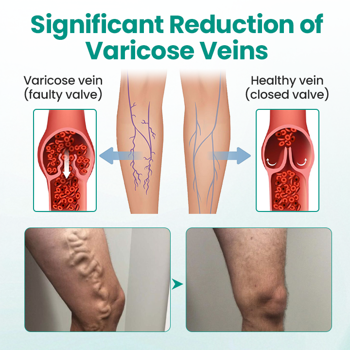 Healrize® LegRenew Varicose Veins Patch✨